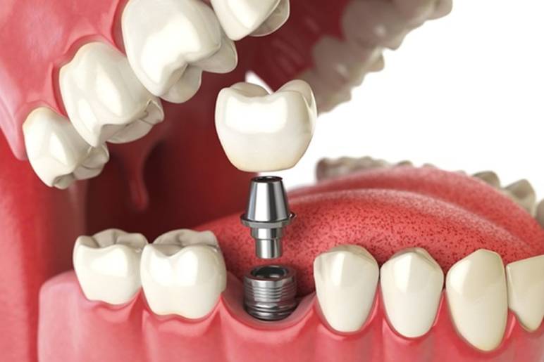 Choosing the Best Dentist for Dental Implants