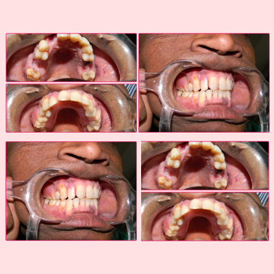 Implant supported overdenture