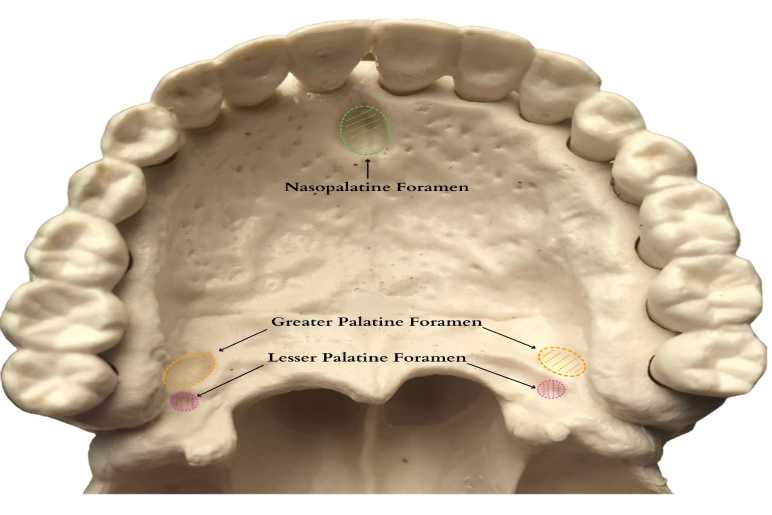 What is the Greater Palatine Nerve Block?