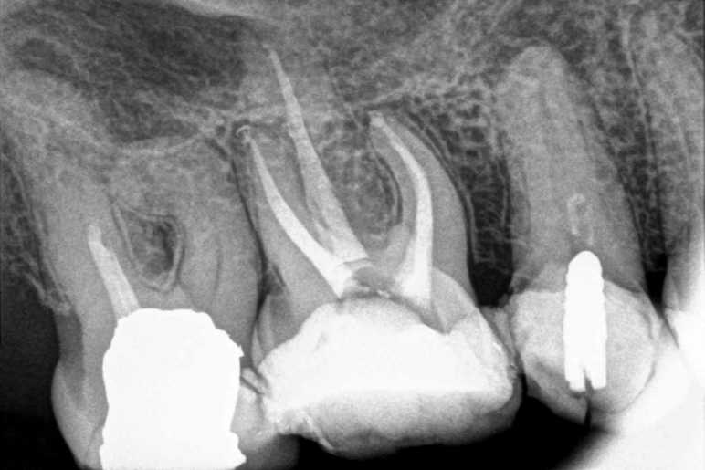 Understanding Maxillary Molar Anatomy