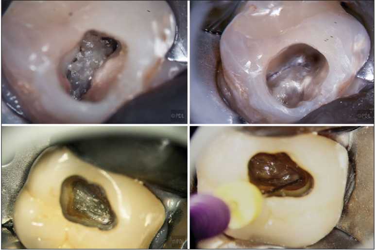 Step-by-Step Guide to Maxillary Molar Access Opening