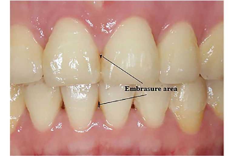 Types of Embrasures