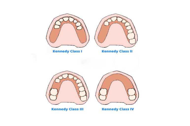 What is the Kennedy Classification?