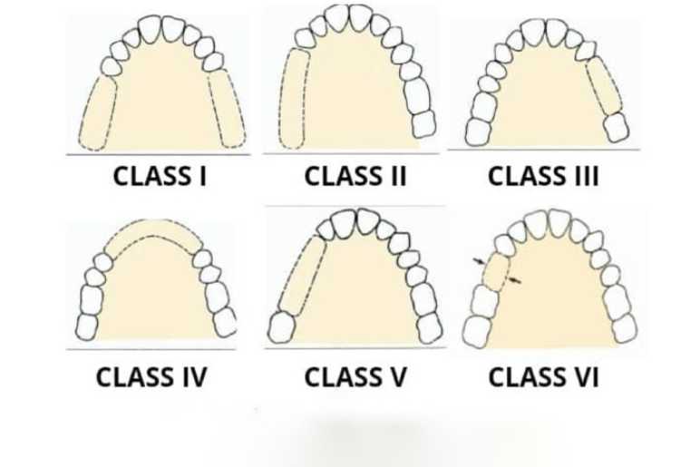 The Four Classes of Kennedy Classification
